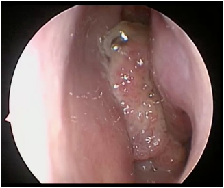 nasal inverted papilloma